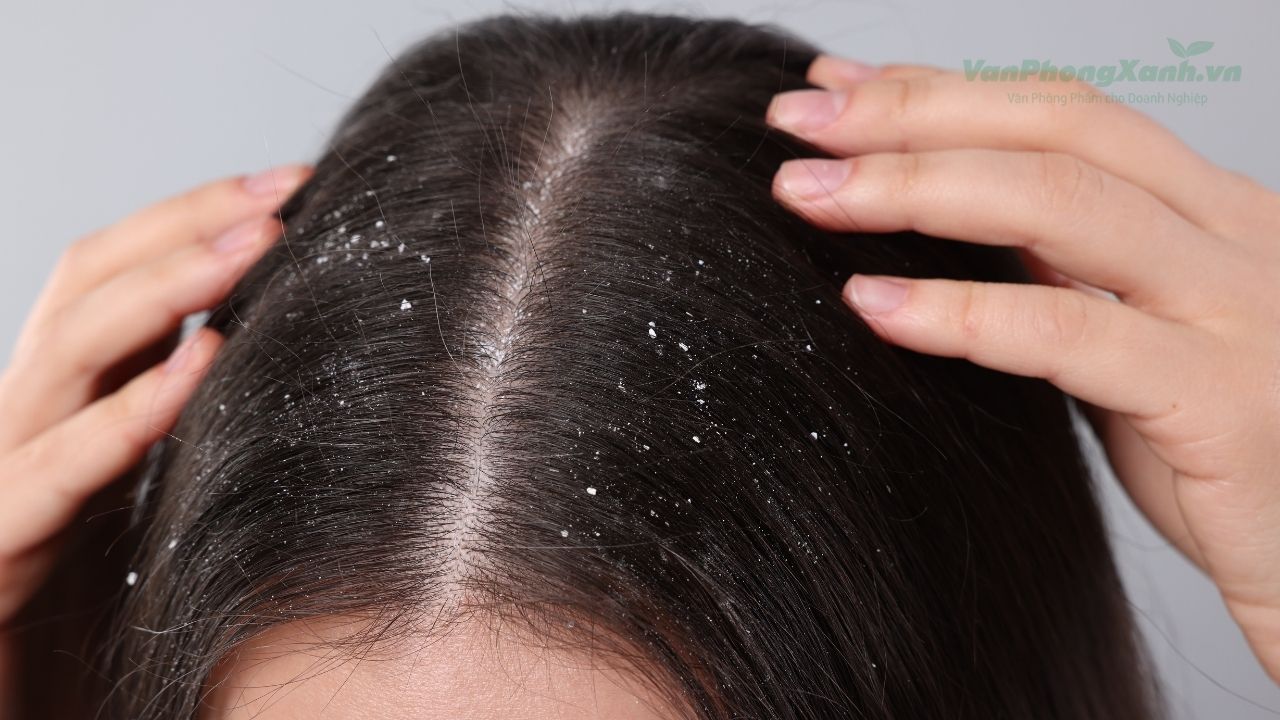 Cách trị gàu hiệu quả tại nhà vào mùa đông